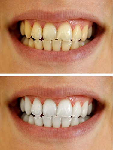 Диспензери за шприц за белење на гел за заби 22% карбамид пероксид за заби за белење на заби 3мл диспензери 6 парчиња