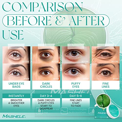 Mashele Aloe Vera Gel Eye Eye Mask Cange - 60 парчиња - хијалуронска киселина колаген под закрпи за очи за темни кругови и подпухналост -