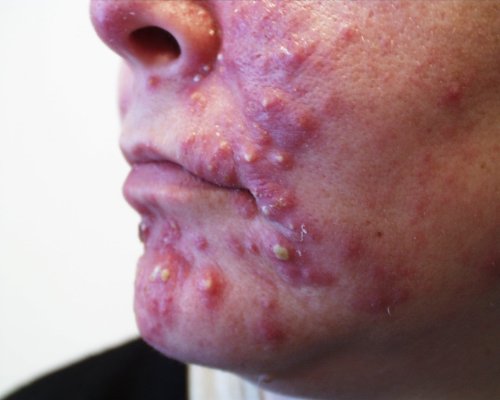 Гриси голем 125г 10% сулфур сапун дерматитис мрсна кожа