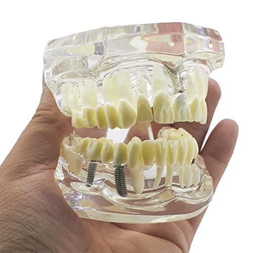 Модел на заби модел за реставрација на стоматолошки имплантација модел типодонт транспарентен отстранлив заболувачки заболувања
