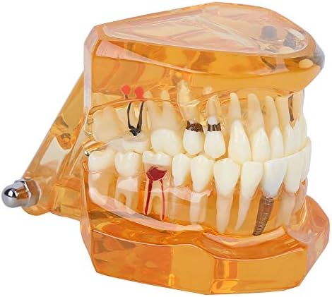 Fafeicy 1pc портокалова модел на заби, заболена болест Отстранлива студија за демонстрација на заби модел, постер/модел